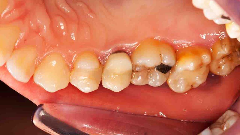 出现什么症状会是牙结石