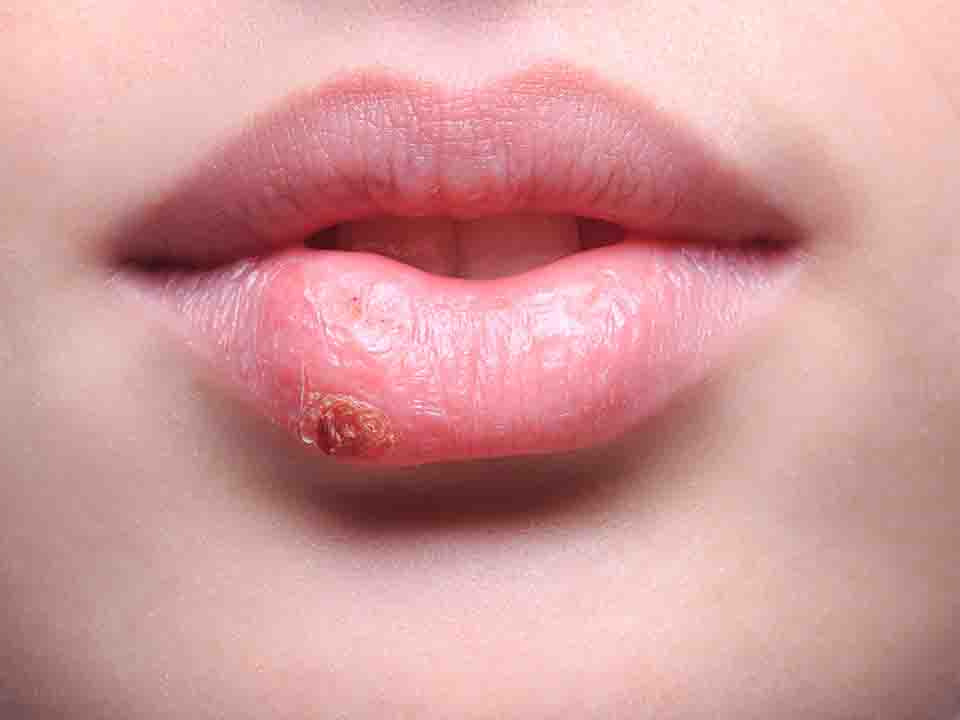 常见的口唇疱疹的症状类型