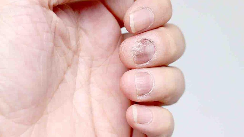 灰指甲症状初期症状