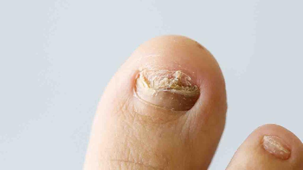 脚灰指甲的治疗方法有哪些