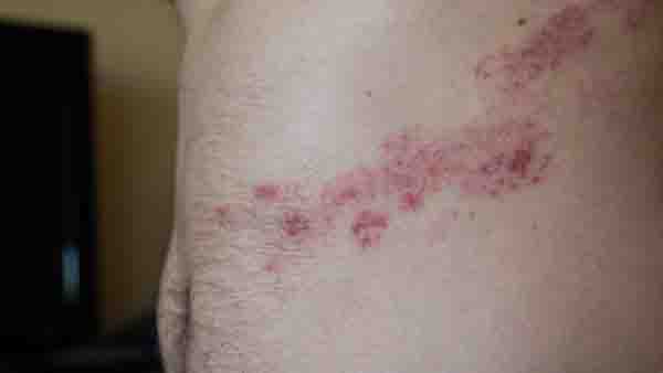 湿疹是怎么引起的