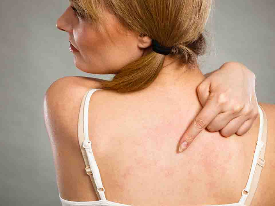 关于皮肤病荨麻疹的常识