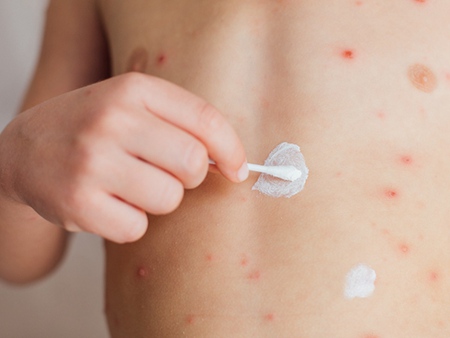 湿疹是怎么引起的？ 预防湿疹的竟然是这3个办法