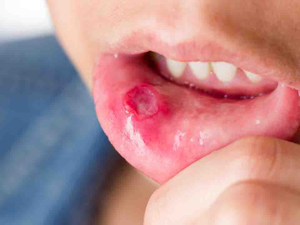 浅析口腔溃疡疾病
