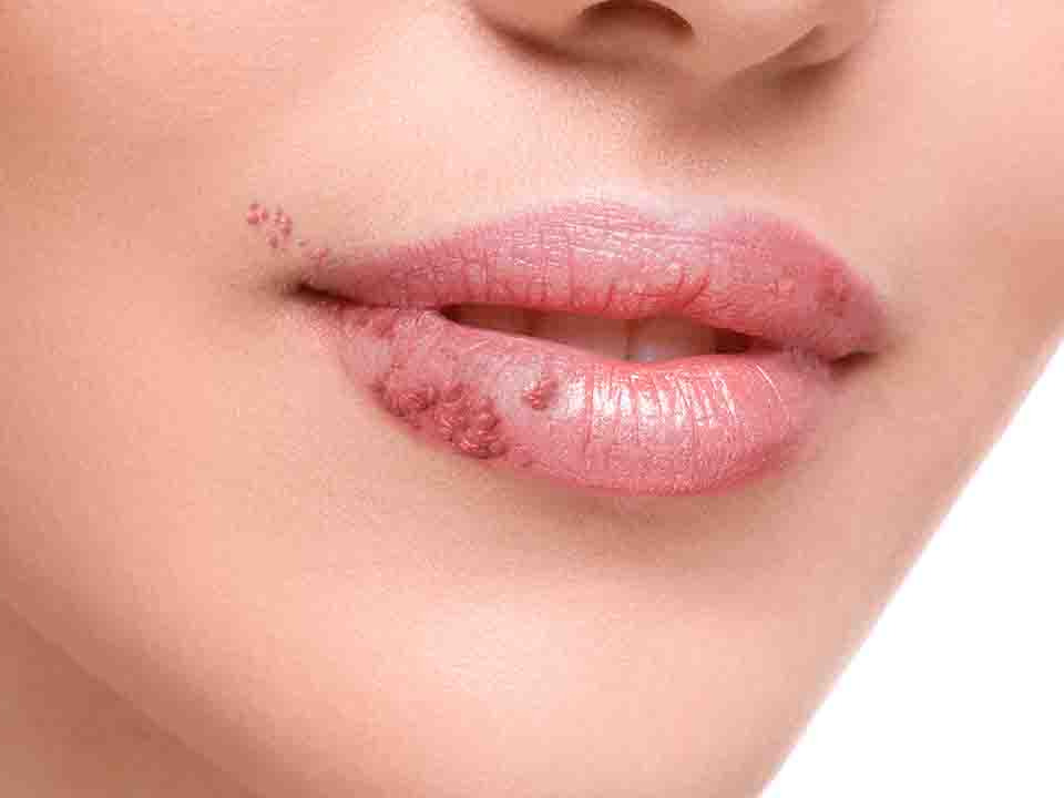 唇炎是什么原因造成的