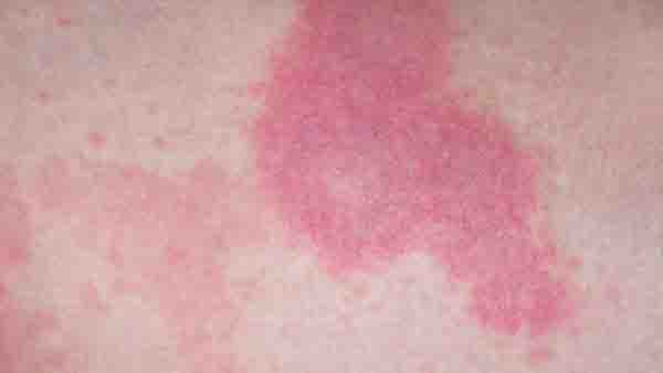 什么是过敏性紫癜综合症