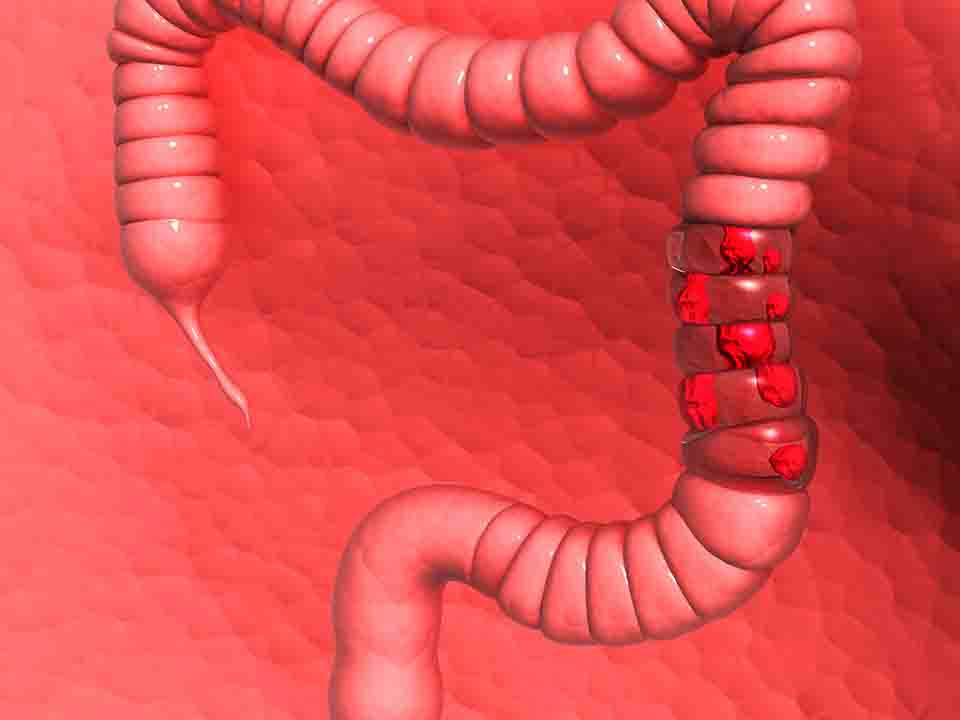 结肠炎对性功能和性欲的影响有哪些