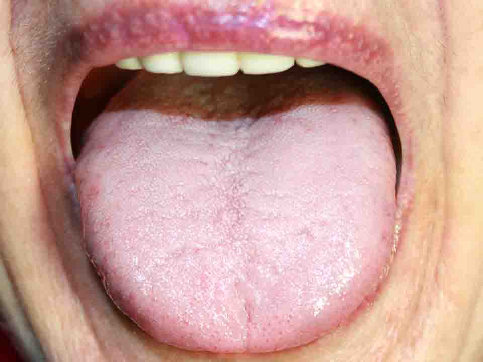舌癌扩散了能活多久