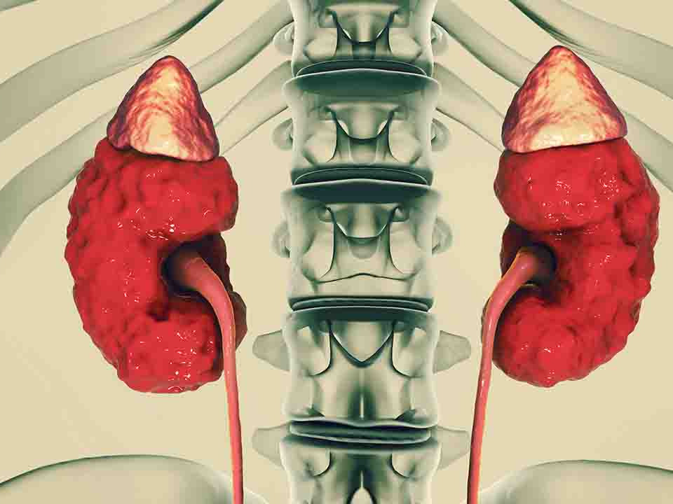 双肾囊肿疾病分析双肾囊肿严重吗