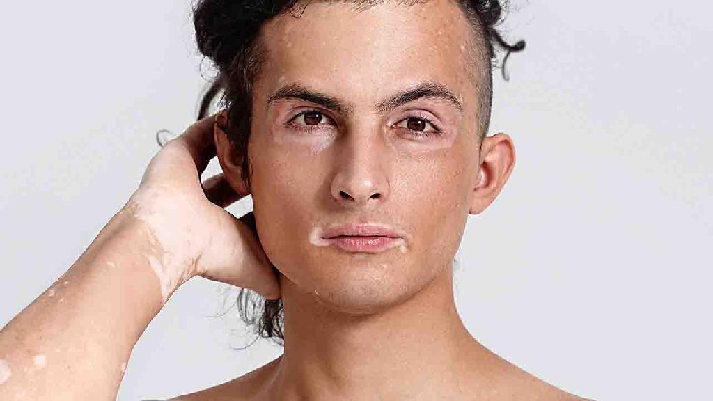 青少年节段性白癜风怎么办