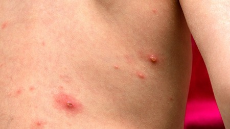 硼酸粉治疗湿疹效果如何？不可长期连续使用