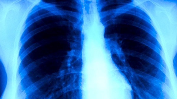 肺炎的危害主要是什么呢？有这5大危害