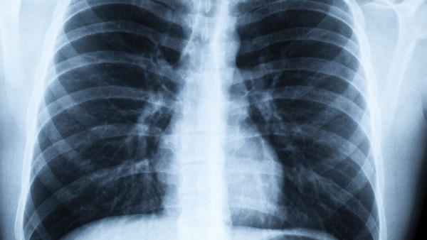 新型冠状感染肺炎CT表现有哪些？有这4种表现
