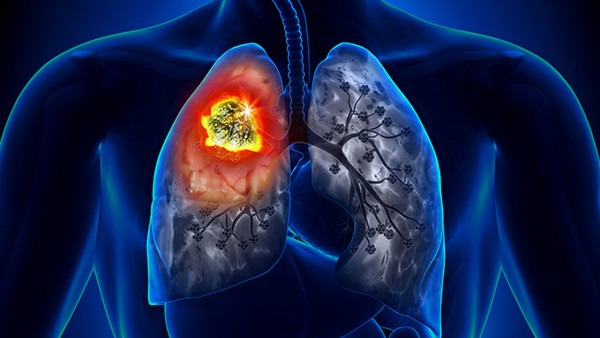 肺炎会有肺结节吗，发现肺结节怎么办？
