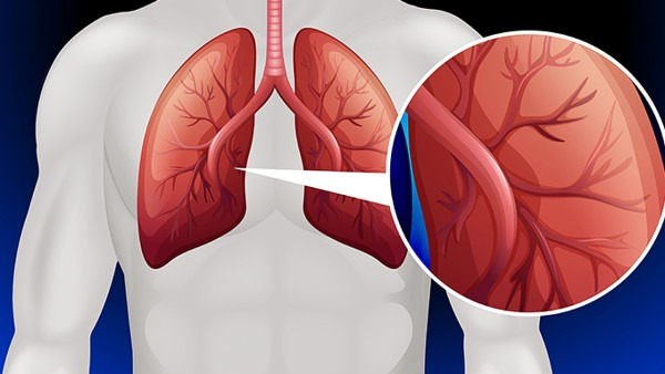 肺结核怎么引起的 感染了肺结核该怎么办