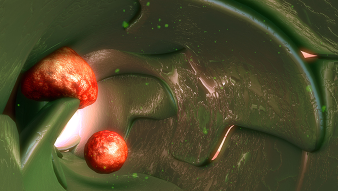 什么是间变性大细胞淋巴瘤 患有间变性大细胞淋巴瘤该怎么办