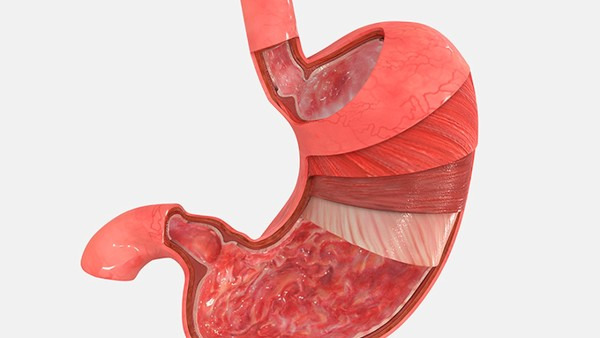 胃出血是什么原因引起的 吃抗凝血的药物也会造成胃出血吗