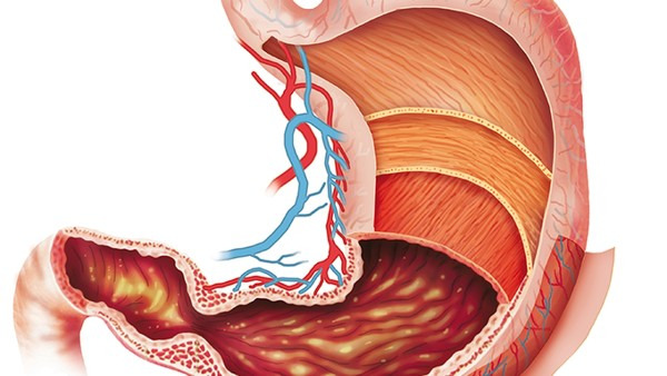 胃出血有多严重 胃出血的危害有哪些