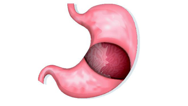 胃出血的症状后果是什么 胃出血会危及生命吗
