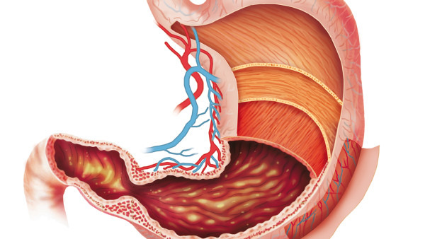 胃出血能自行痊愈吗 胃出血的常见病因都有哪些