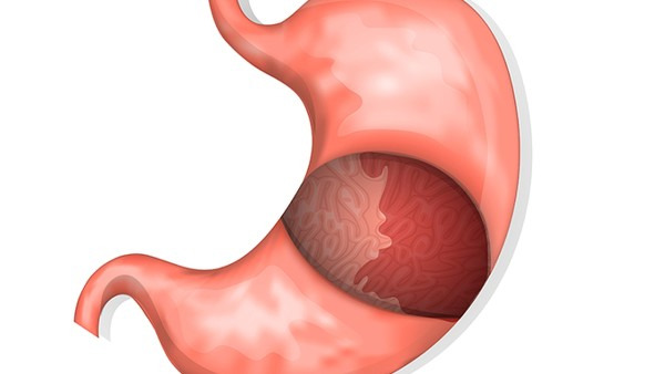 慢性浅表性胃炎的病因 导致慢性浅表性胃炎的5个病因