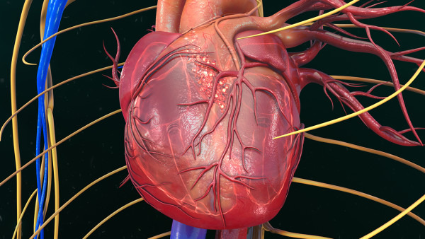 心肌梗塞会遗传吗 如何降低心肌梗塞的发病率