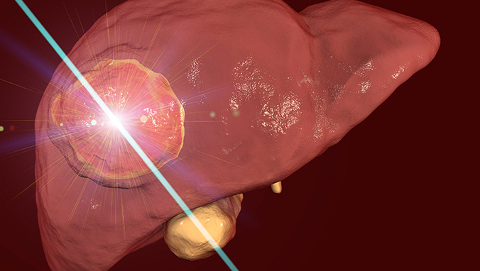 肝管癌晚期可能治好吗？有可能