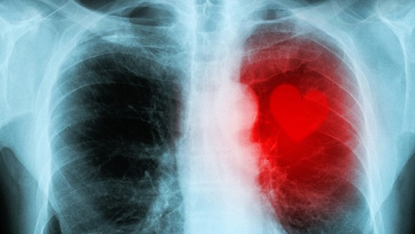 肺癌会复发吗？为什么容易复发？