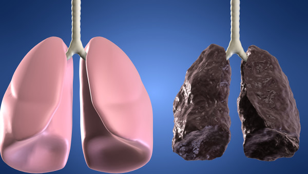 肺癌化疗有什么副作用？这五点需注意