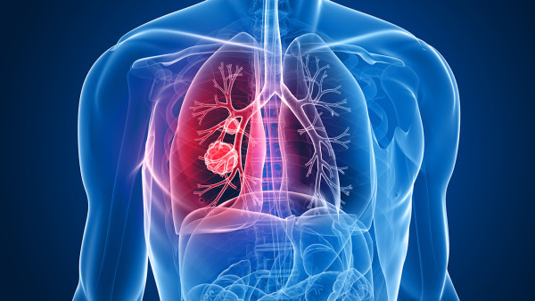 肺癌的放疗是什么？该怎么护理？