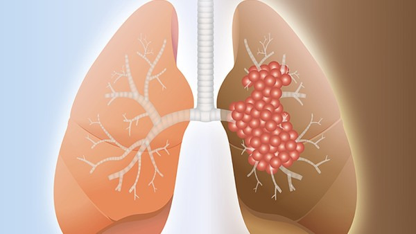 什么是肺部肿瘤？分为两种