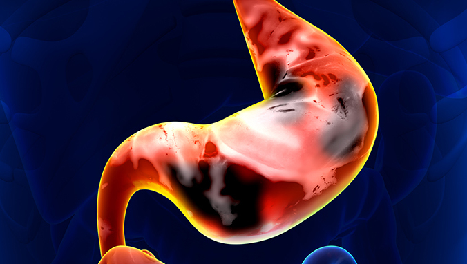 早期胃癌能治愈吗