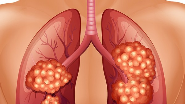 肺部肿瘤和肺癌有什么关系？肺癌是包含在肺部肿瘤之中
