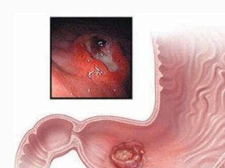 肠胃癌能治好吗