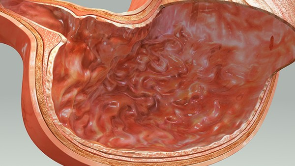 胃癌图片和胃糜烂图片图片