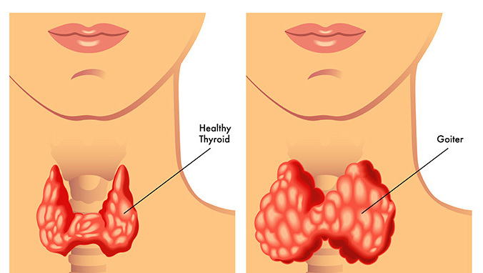 甲狀腺乳頭狀微小癌能活多久 影響甲狀腺乳頭狀微小癌存活期的因素都有哪些