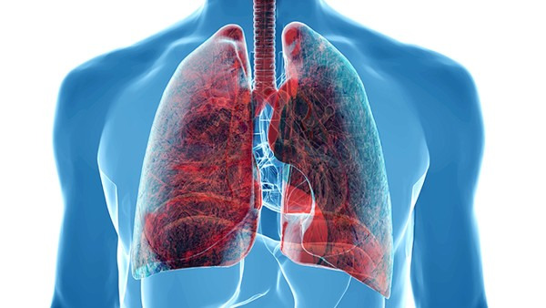 小细胞肺癌必须化疗吗？化疗是首选