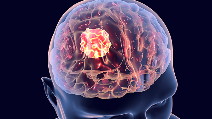脑瘤和脑癌一样吗 脑瘤和脑癌的区别是什么