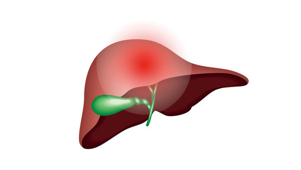 膽管癌早期有什么癥狀？注意這四種癥狀