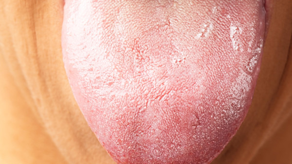 舌癌的早期症状都有哪些 舌癌早期会影响患者的舌头活动吗