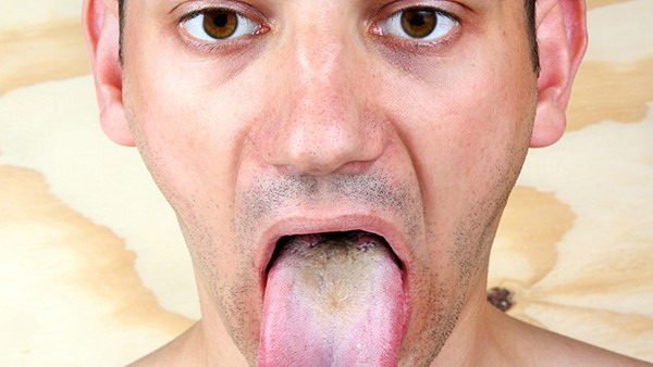 舌癌早期症状是什么