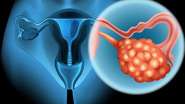 卵巢癌是什么病 怎么治疗卵巢癌