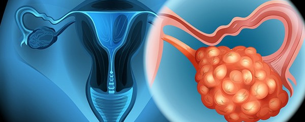 子宫内膜癌能治愈吗？分三个时期