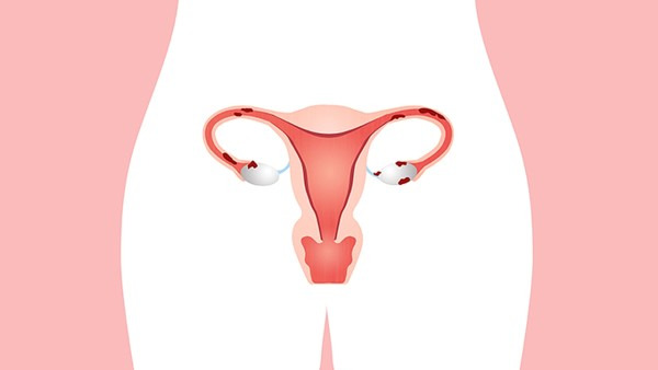 子宫内膜癌有哪些早期症状？这三个症状需注意