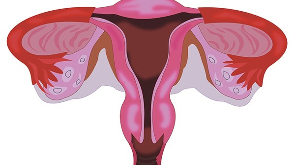 得了卵巢肿瘤严重吗？分生理性和病理性