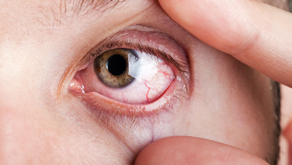 眼睛老流眼泪是怎么回事 导致眼睛老流眼泪的4个病因