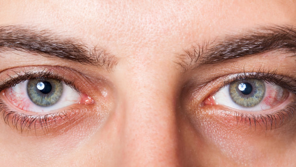 眼酸流泪是怎么回事 导致眼酸流泪的3个原因