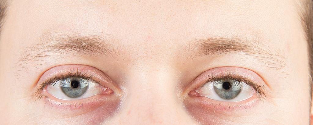 眼红怎么回事 导致眼红的4个病因