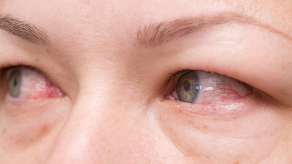 白眼球上有血丝是怎么回事 白眼球上有血丝的原因