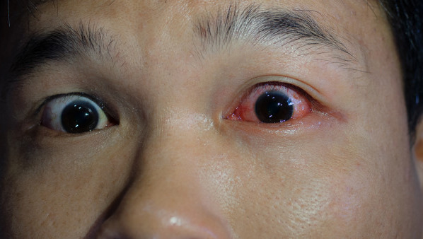 眼结膜下出血怎么办 眼睛结膜下出血的原因